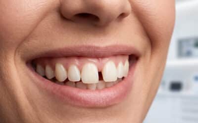 Diastema: Urok czy Problem?